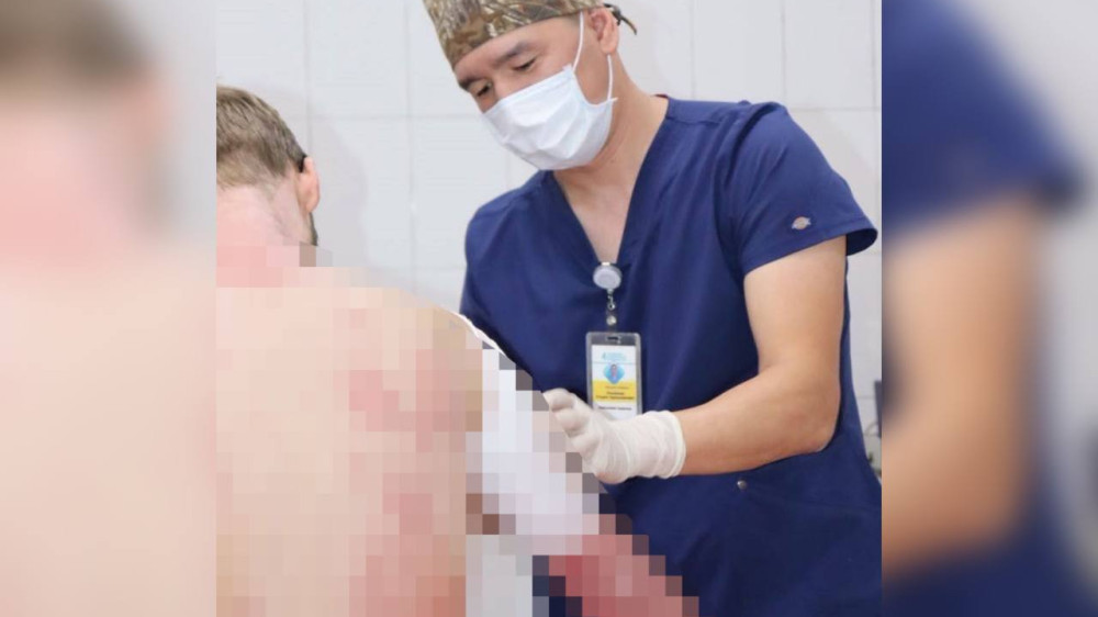 В Алматы спасли мужчину с ожогами почти 90 процентов тела